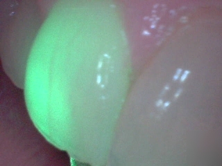 Low level lasers for dental treatment and lllumination